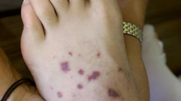 Article image for A timely meningococcal warning