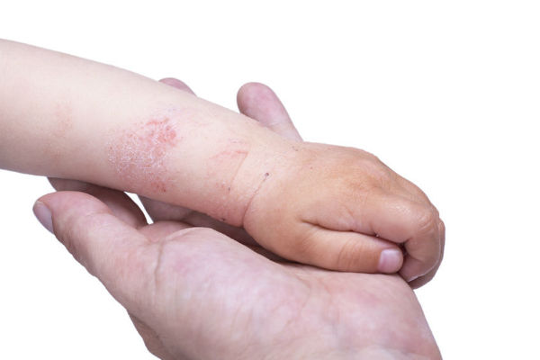 Article image for Why is eczema worse in the Winter