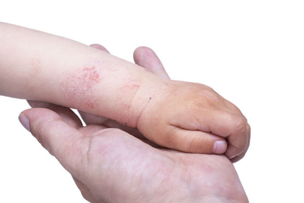 Why is eczema worse in the Winter