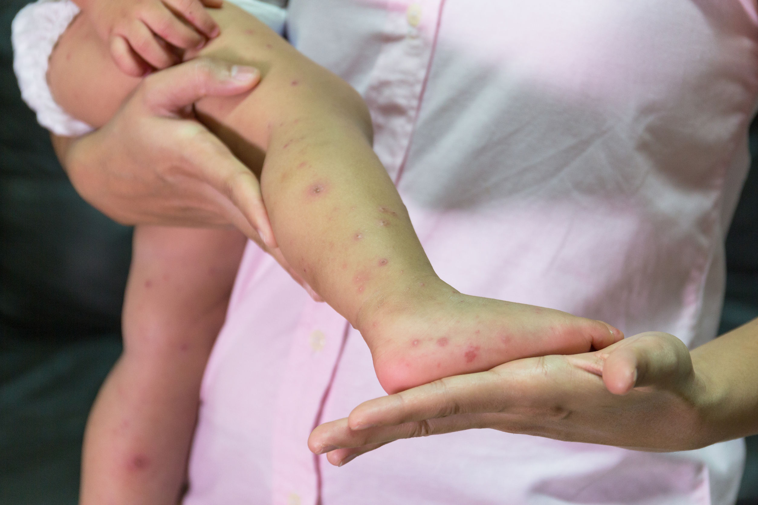 Measles outbreak worsens: 13 now diagnosed