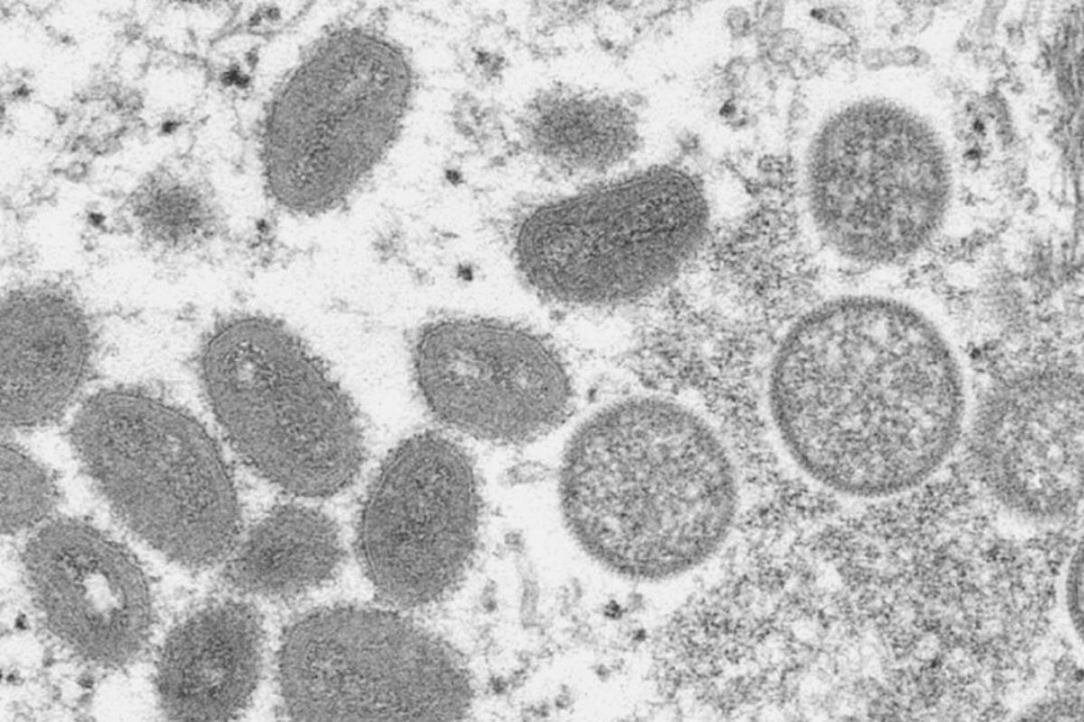 Article image for Monkeypox virus hits Australian shores for the first time