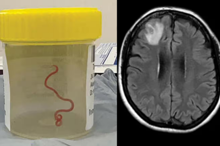 Huge roundworm removed from woman’s brain the first case of its kind
