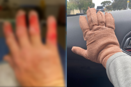 Hikers serious hand burn is wake-up call for all campers